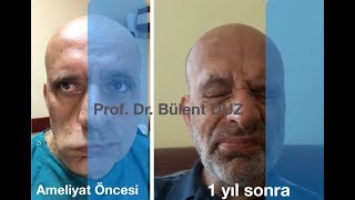 Yüz felci ameliyatı - Prof Dr. Bülent DÜZ