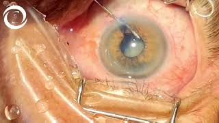 Blind capsulorrhexis in a small pupil