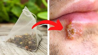 How to Get Rid of Herpes Symptoms Naturally | Health Tips