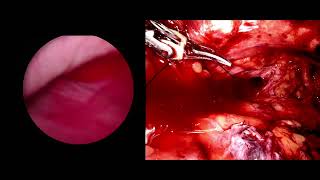 #165 Robot Assisted Complex Prostatic Urethrocutaneous Fistula Excision Dr. Gautam Ram Choudhary