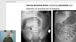 Paediatric surgery in Arabic 8 ( Meconium Ileus) ,  by Dr, Wahdan