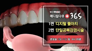 [메디컬다큐365]자신있는삶 디지털 풀아치 / 부인과 종양 치료 단일공 복강경 수술 (23.05.01 예고편)