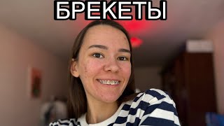 БРЕКЕТЫ | УСТАНОВКА БРЕКЕТОВ | ЦЕНА И ВПЕЧАТЛЕНИЯ