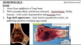 Osteoclastoma | giant cell tumour | pathology mbbs