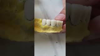 Anterior crown #smiledentist #musicgenre #dentalclinic #dental #musicsong #veneers