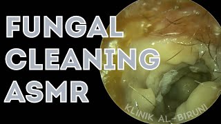 ASMR Ear Fungal Cleaning