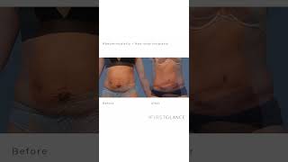 Full Tummy Tuck & Neo-Umbilicoplasty