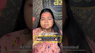 Acne scar and pigmentation skin makeup coverage. #correction #makeuptutorial #acnescars  #goviral