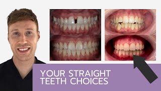 What Are My Straight Teeth Choices?