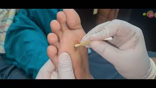 Foot corn removal by laser || By Dr.Arif Iqbal