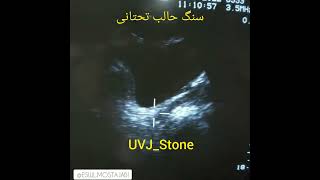 uvj stone ESWL