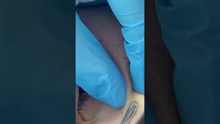 Blackhead extraction