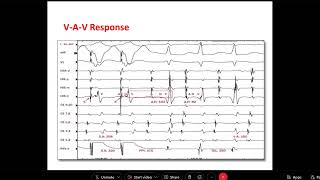 Narrow Complex Tachcardia   Dr  Mohamed Adam