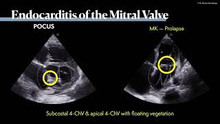 〖Echocardiography〗 Mitral valve endocarditis 🫀