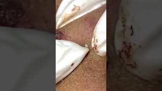 Big Cystic Acne Blackheads Extraction Blackheads & Milia, Whiteheads Removal Pimple Popping