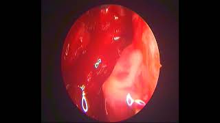 Endoscopic DCR incising sac mucosal layer-dr.shreekantha acharya