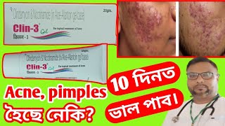 Clin 3 gel || clin 3gel review | clindamycin | শাল মইনা ৰ cream | acne treatment | health tips ikbal