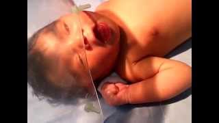 Medical Education Video: Neonatology: Seizure in newborn - Clonic movements