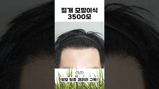 절개 모발이식 3500모 1년