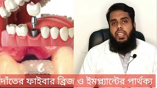 দাঁতে ফাইবার ব্রিজ এবং ইমপ্ল্যান্ট কিভাবে করা হয় এর খরচ ও বিস্তারিত। Tech Dental