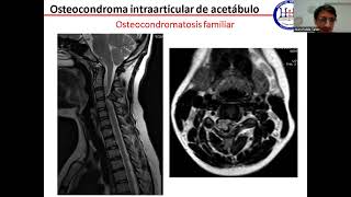 Osteocondroma intraarticular de acetábulo