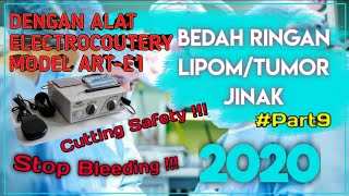 LIPOMA REMOVAL SURGERY, Operasi Lipoma | Tumor Jinak