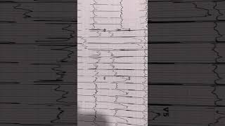 #ecg #icu TAPVD/TAPVC- right axis- lead I & aVF, tall P wave-RA enlarged, tall R-V3,V4- RV enlarged