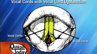 Vocal Cord Dysfunction