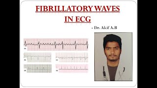 Fibrillatory(F) Wave in ECG