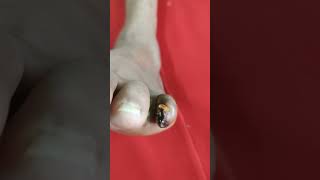 Wockard Mira Road Hospital messed up my diabetic toe