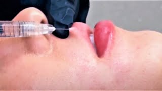 Watch This Lip Filler Treatment With Vollure Using The Russian Lip Technique AT Mirror Mirror!