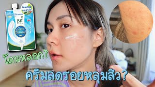 ลองของใหม่! ครีมลดรอยสิว หลุมสิวตื้น! ดีจริงหรือจกตา!? | This is Pear