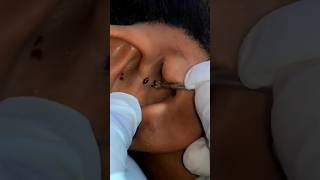 Blackheads in Ear