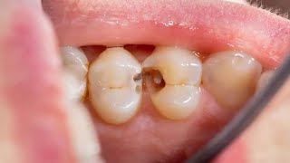 Causes of cavities in between the teeth