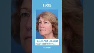 Facelift, Necklift, Upper & Lower Blepharoplasty✨