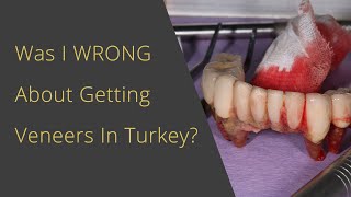 Was I WRONG about Veneers In Turkey??!