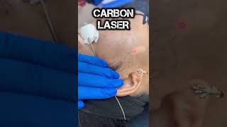 carbon laser treatment#carbonlaserfacial#carbonlaserpeel#facials#skincare