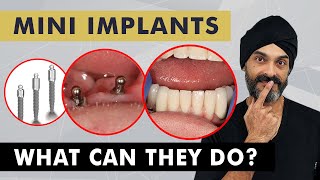 Mini Dental Implants What Can They Do