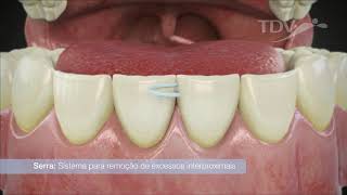 Microcut TDV   Remoção de excessos