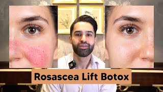 Benefits of Rosacea Botox