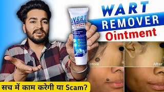 Wart Remover Cream Review | Wart Remover Ointment