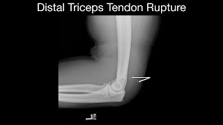 Distal Triceps Tendon Rupture