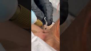 Skin Tag Removal #shorts #fibroblast