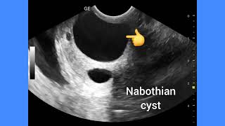 Large Nabothian cyst of cervix, Transabdominal and TVS, ultrasound, overview, management