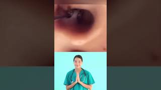 Dr.Nattacha, blackheads ears removal, extraction.