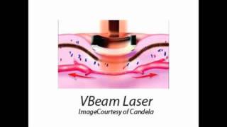 vbeam laser rosacea spider veins facial veins santa monica beverly hills