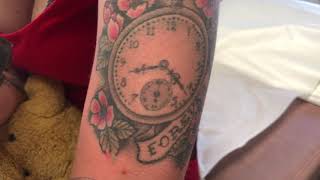 Laser tattoo removal on woman’s upper arm