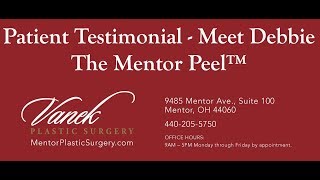 Meet Debbie - Her Testimonial of The Mentor Peel™