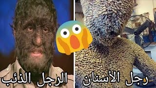 شخصان أحدهما جسده مغطى تماما بالأسنان و الآخر بالشعر 😲