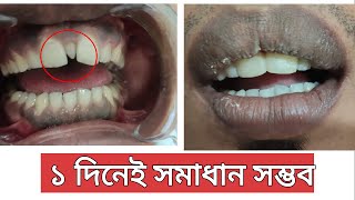 মাঝের ছোট দাঁতের চিকিৎসা। Mesiodens Treatment. ফাঁকা দাঁতের চিকিৎসা। Tech Dental